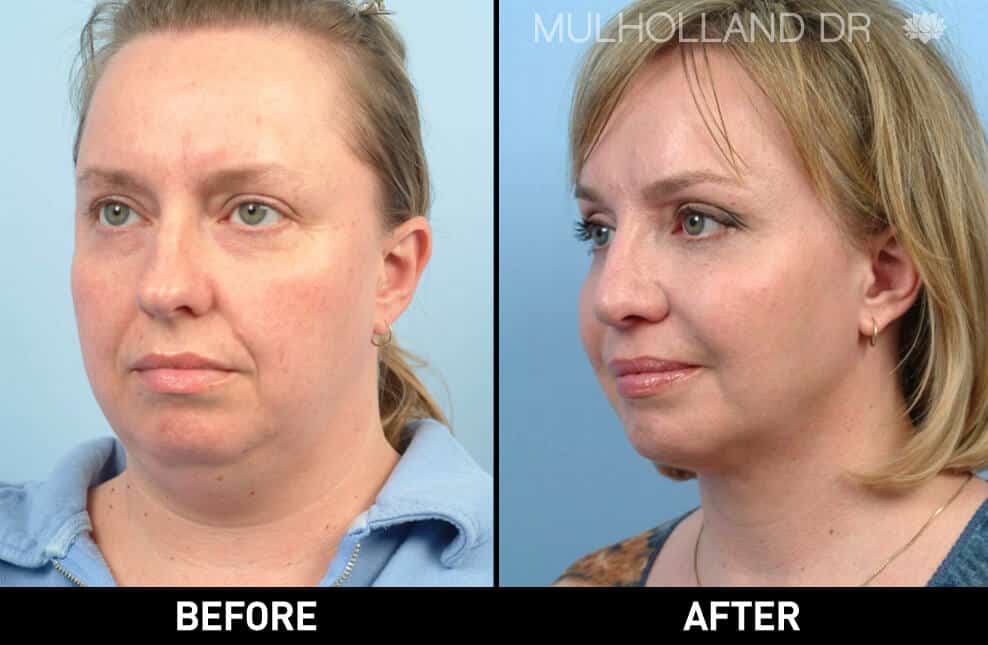 Cheek Lift - Before and After Gallery - Patient Photo 61