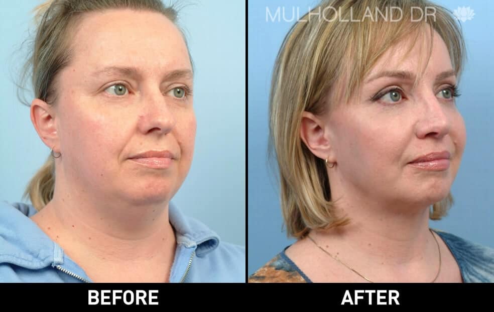 Cheek Lift - Before and After Gallery - Patient Photo 62