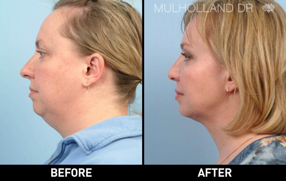 Cheek Lift - Before and After Gallery - Patient Photo 63