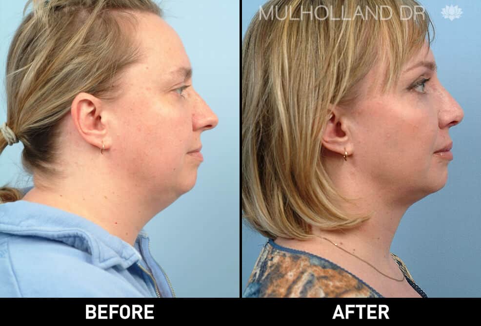 Cheek Lift - Before and After Gallery - Patient Photo 64