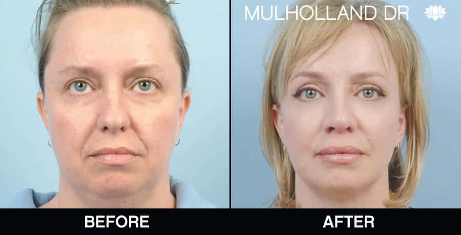 Cheek Lift - Before and After Gallery - Patient Photo 65