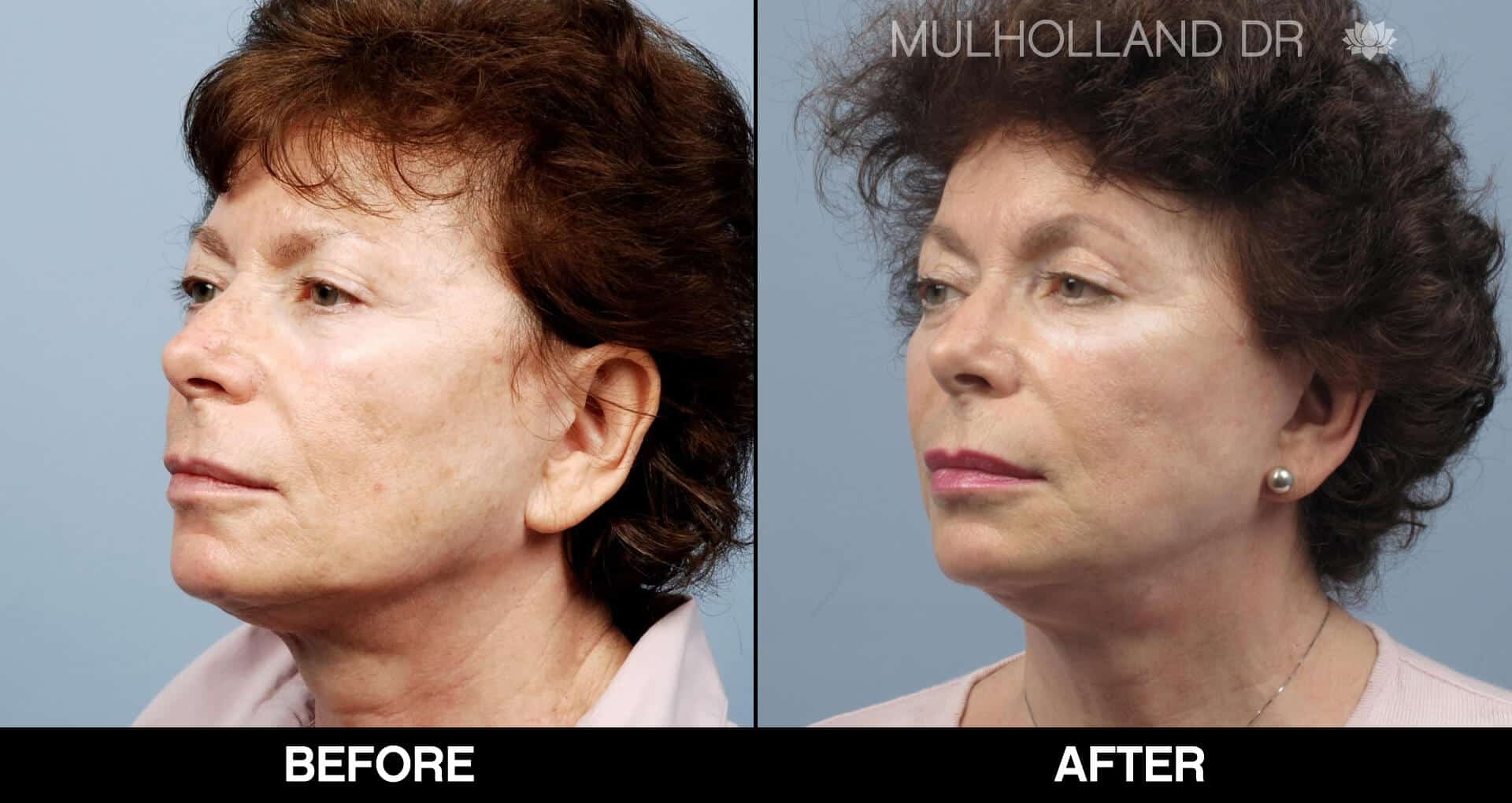 Cheek Lift - Before and After Gallery - Patient Photo 67