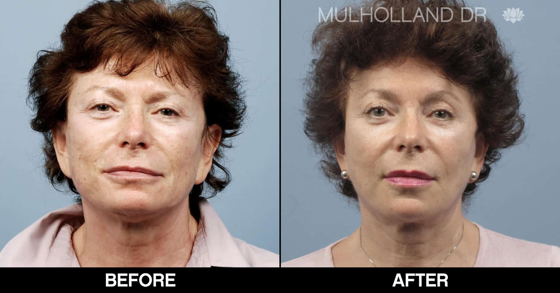 Cheek Lift - Before and After Gallery - Patient Photo 68