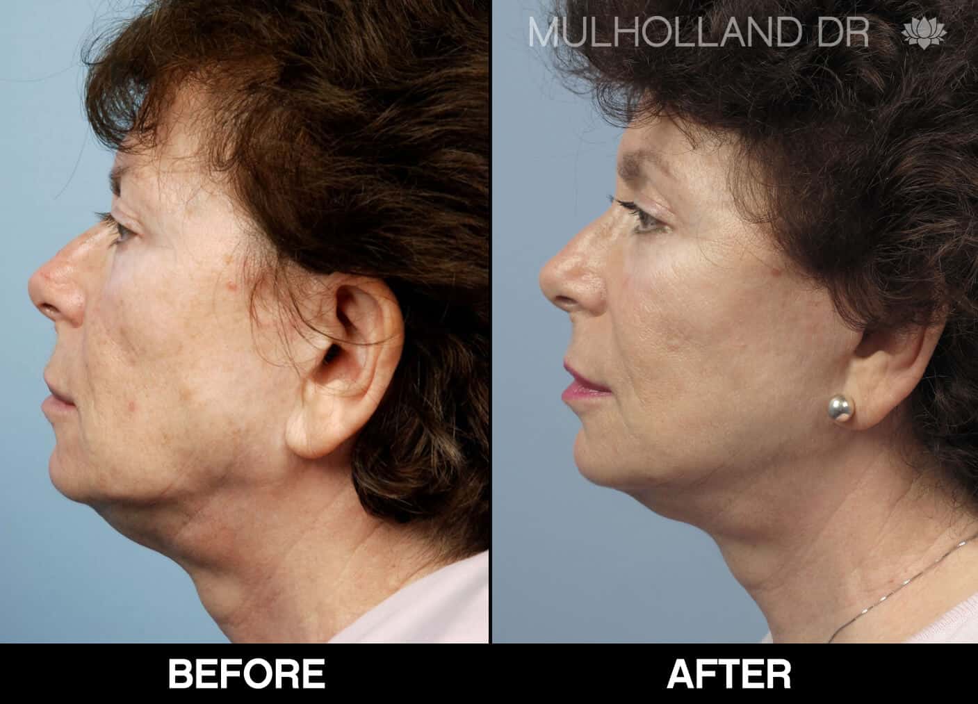 Cheek Lift - Before and After Gallery - Patient Photo 69