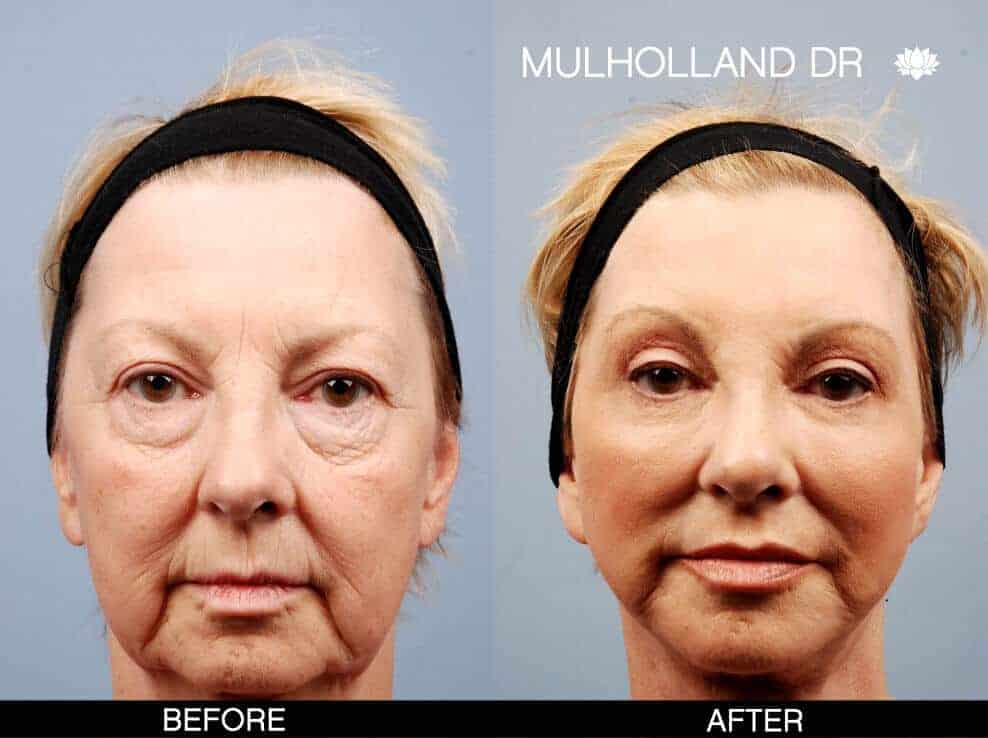 Cheek Lift - Before and After Gallery - Patient Photo 7