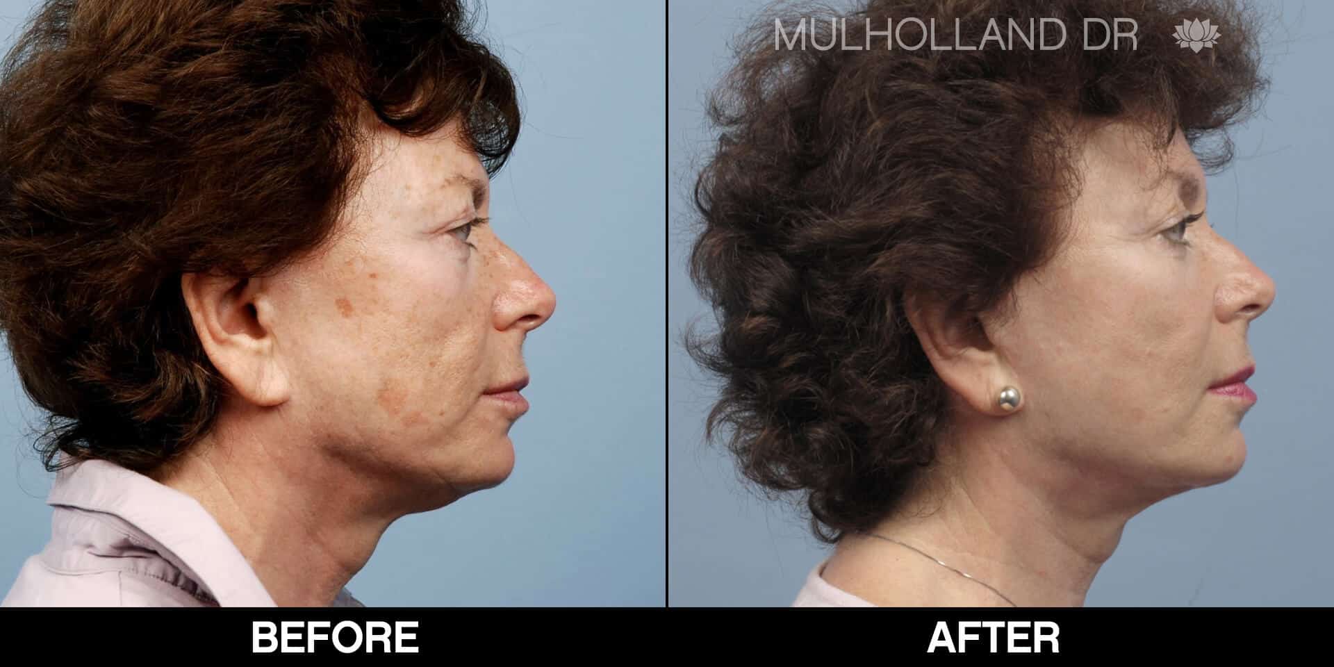 Cheek Lift - Before and After Gallery - Patient Photo 70
