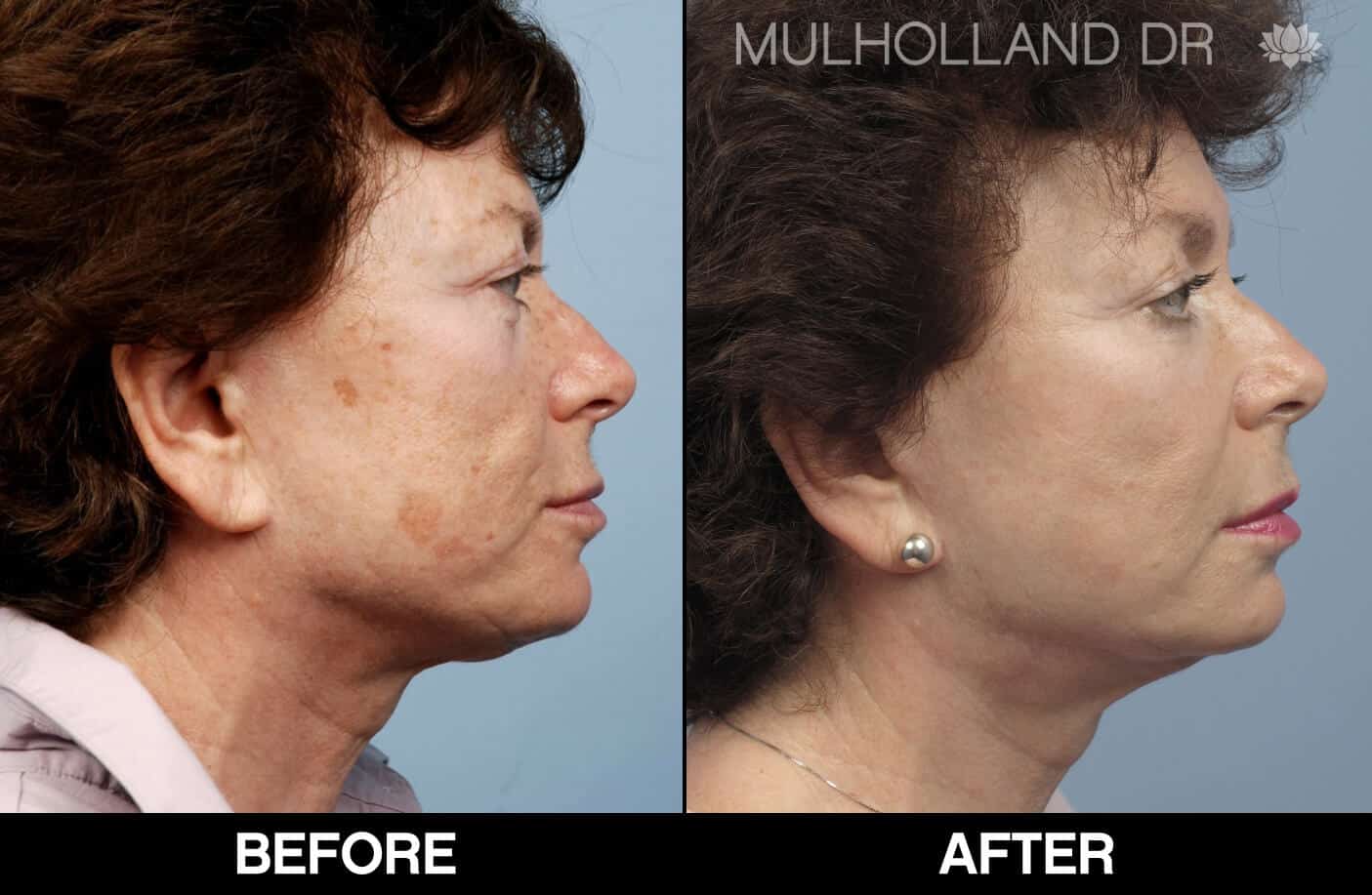Cheek Lift - Before and After Gallery - Patient Photo 71