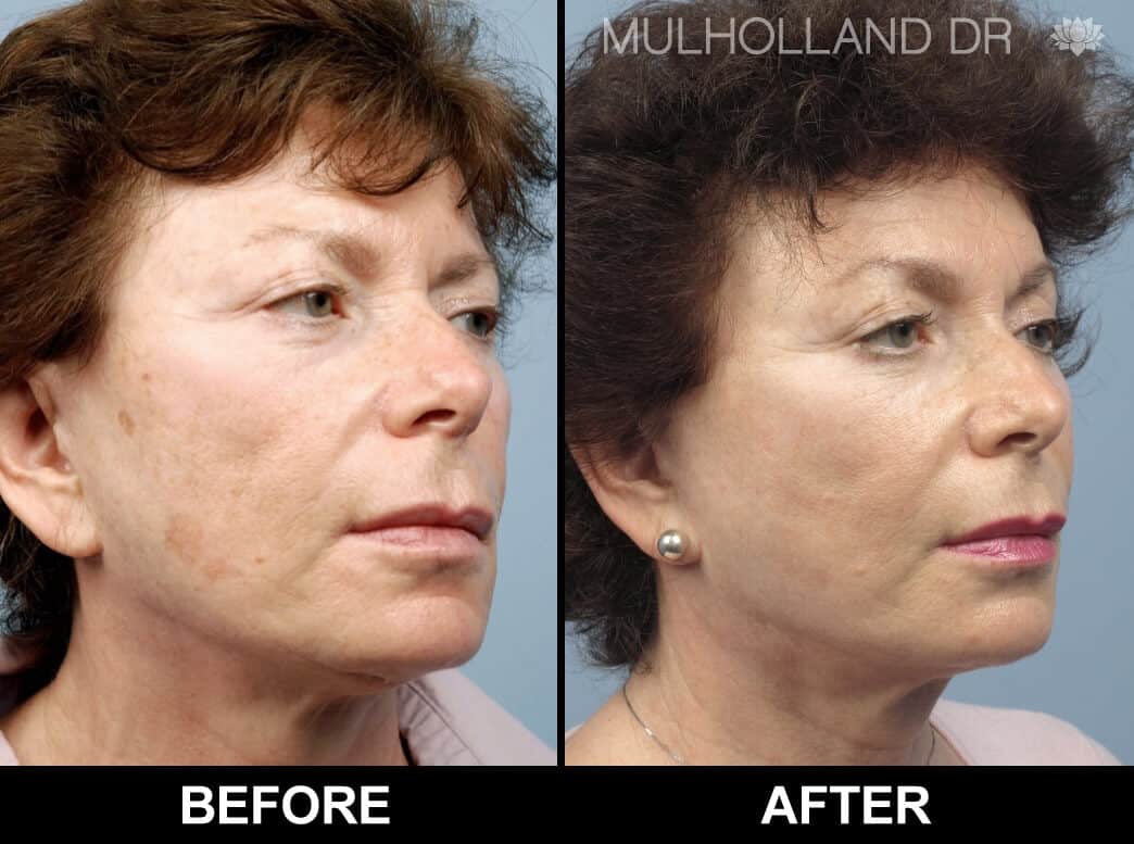 Cheek Lift - Before and After Gallery - Patient Photo 72