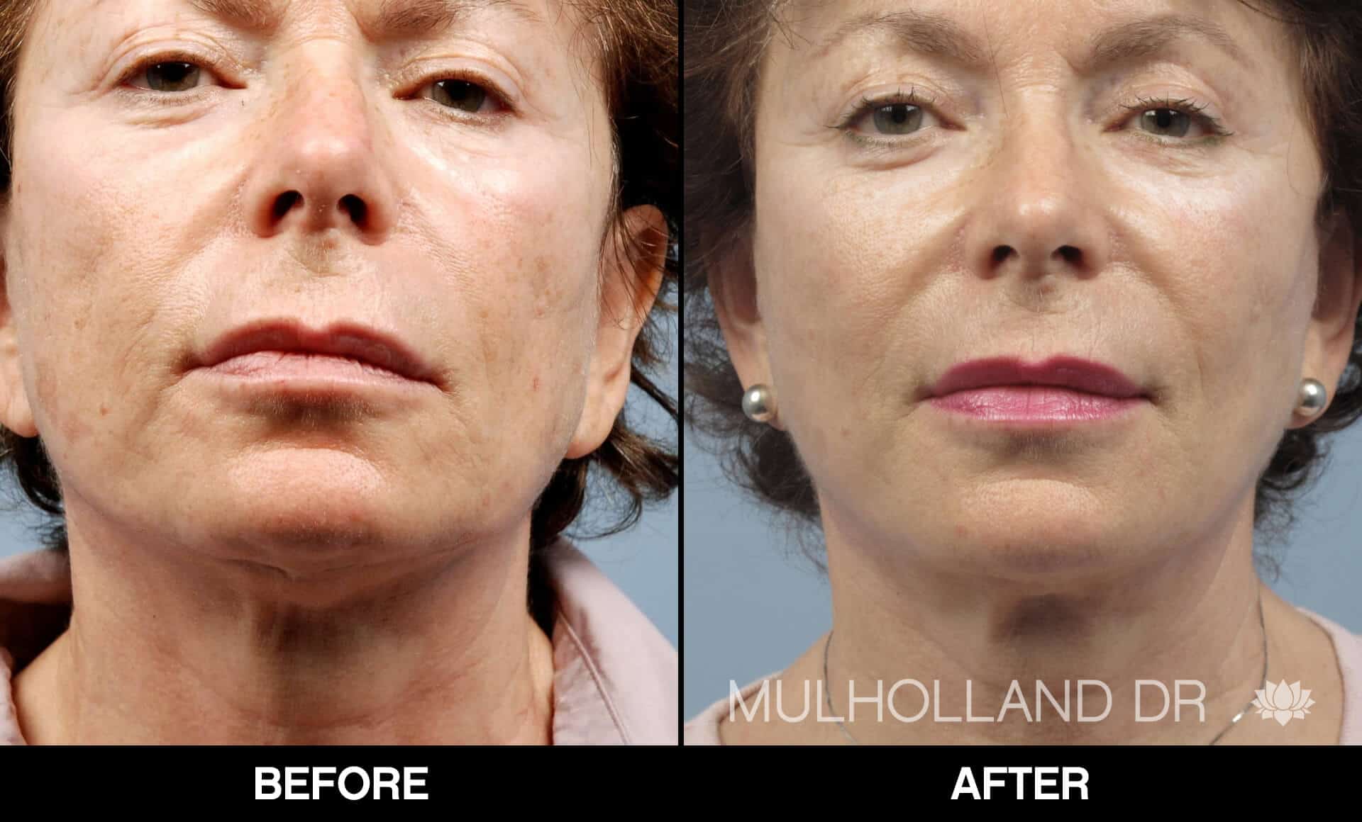 Cheek Lift - Before and After Gallery - Patient Photo 73