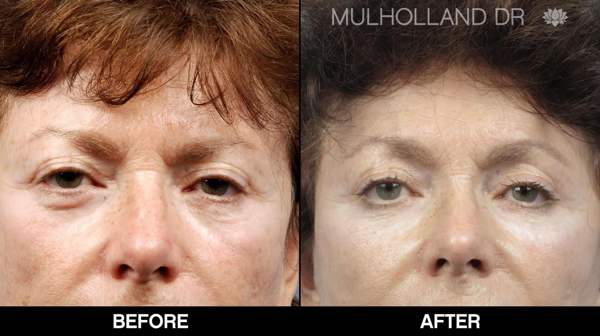 Cheek Lift - Before and After Gallery - Patient Photo 74