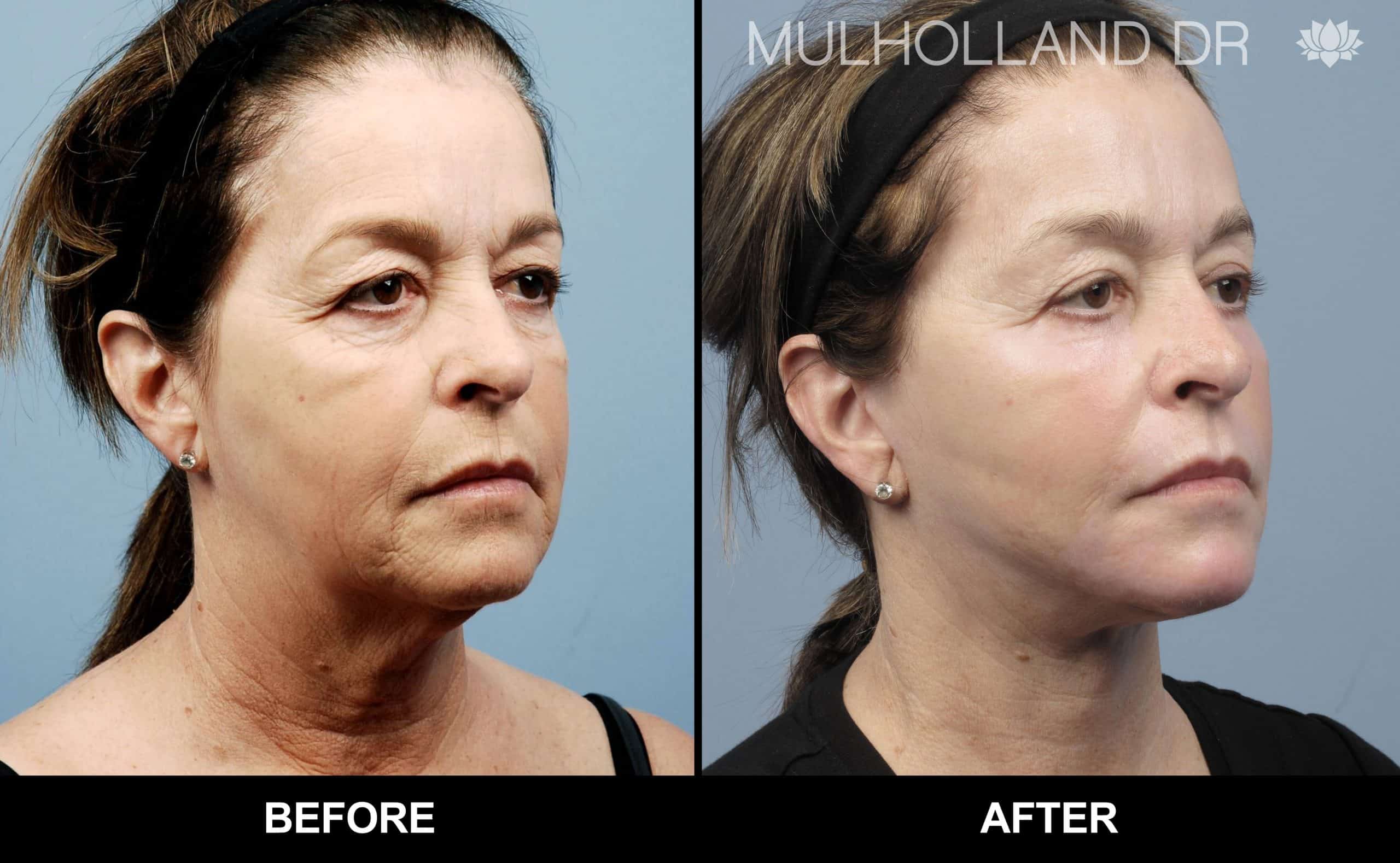 Cheek Lift - Before and After Gallery - Patient Photo 76