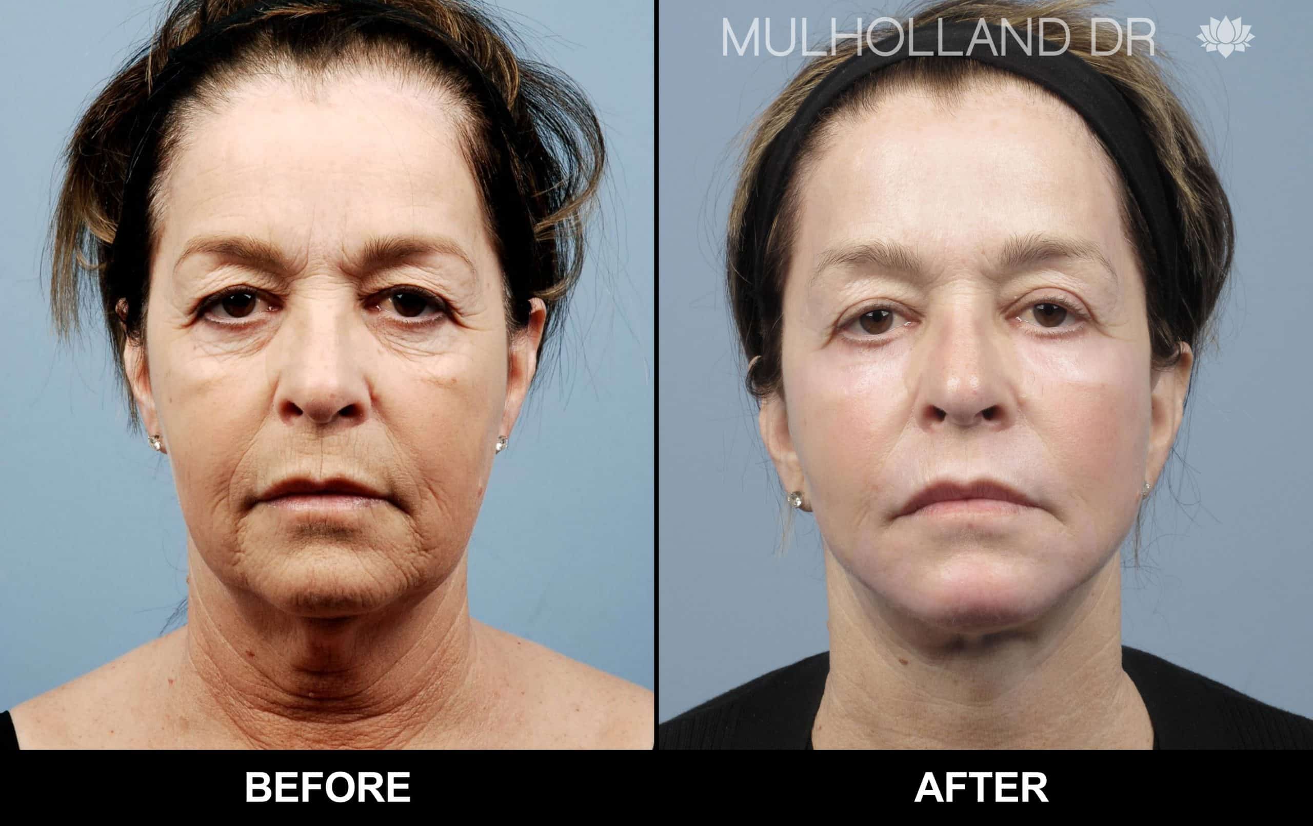 Cheek Lift - Before and After Gallery - Patient Photo 77