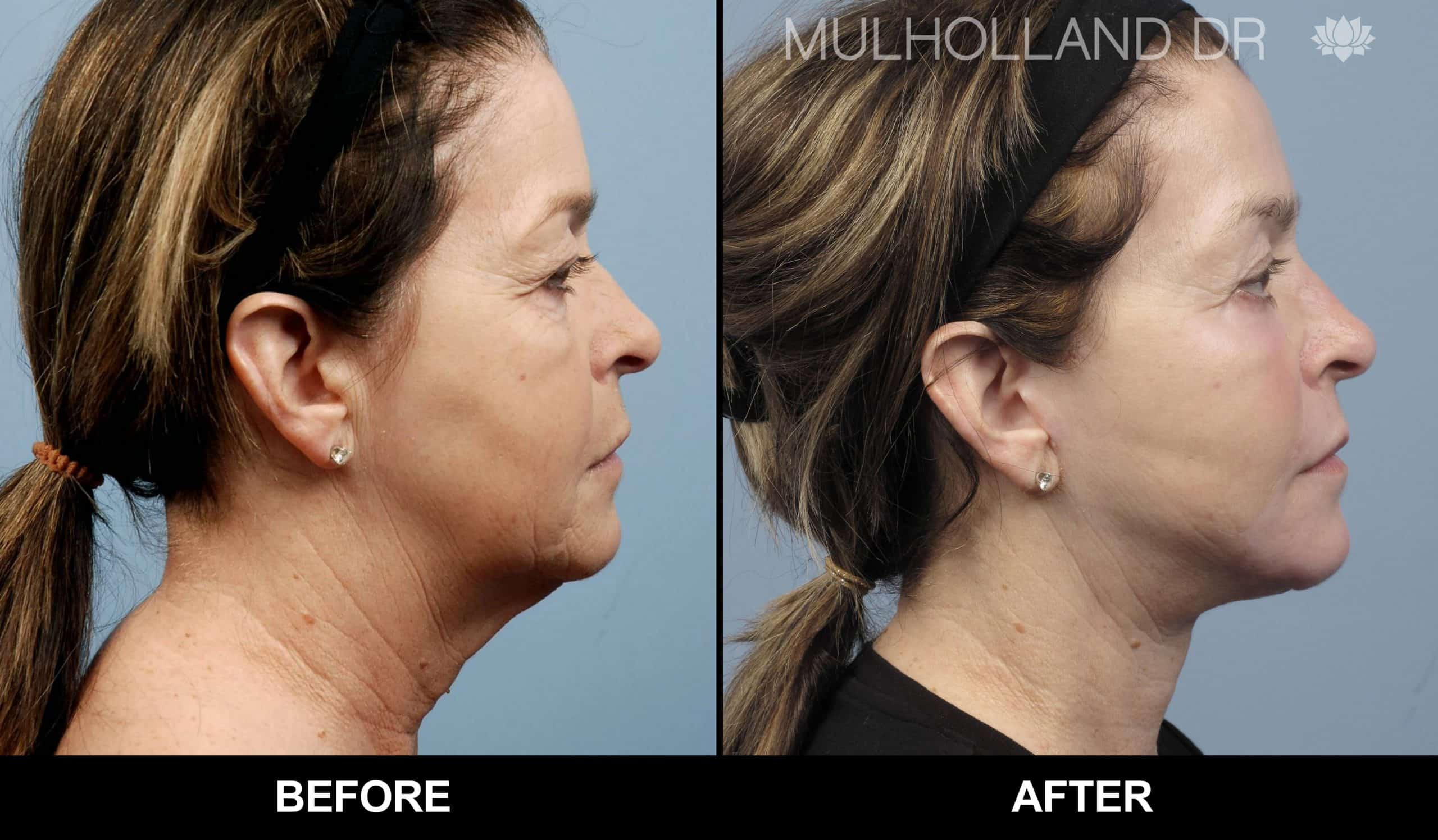 Cheek Lift - Before and After Gallery - Patient Photo 79
