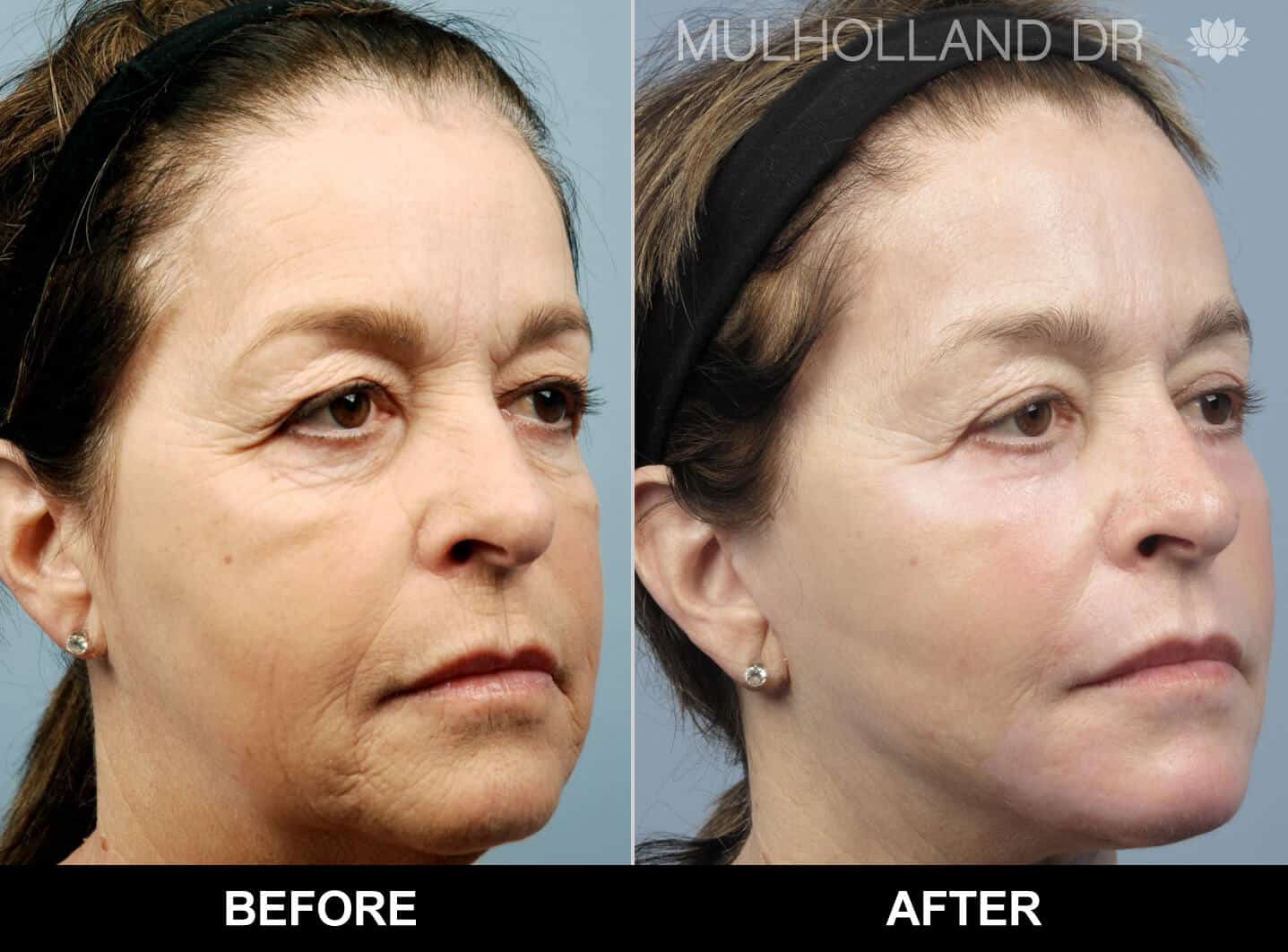 Cheek Lift - Before and After Gallery - Patient Photo 80