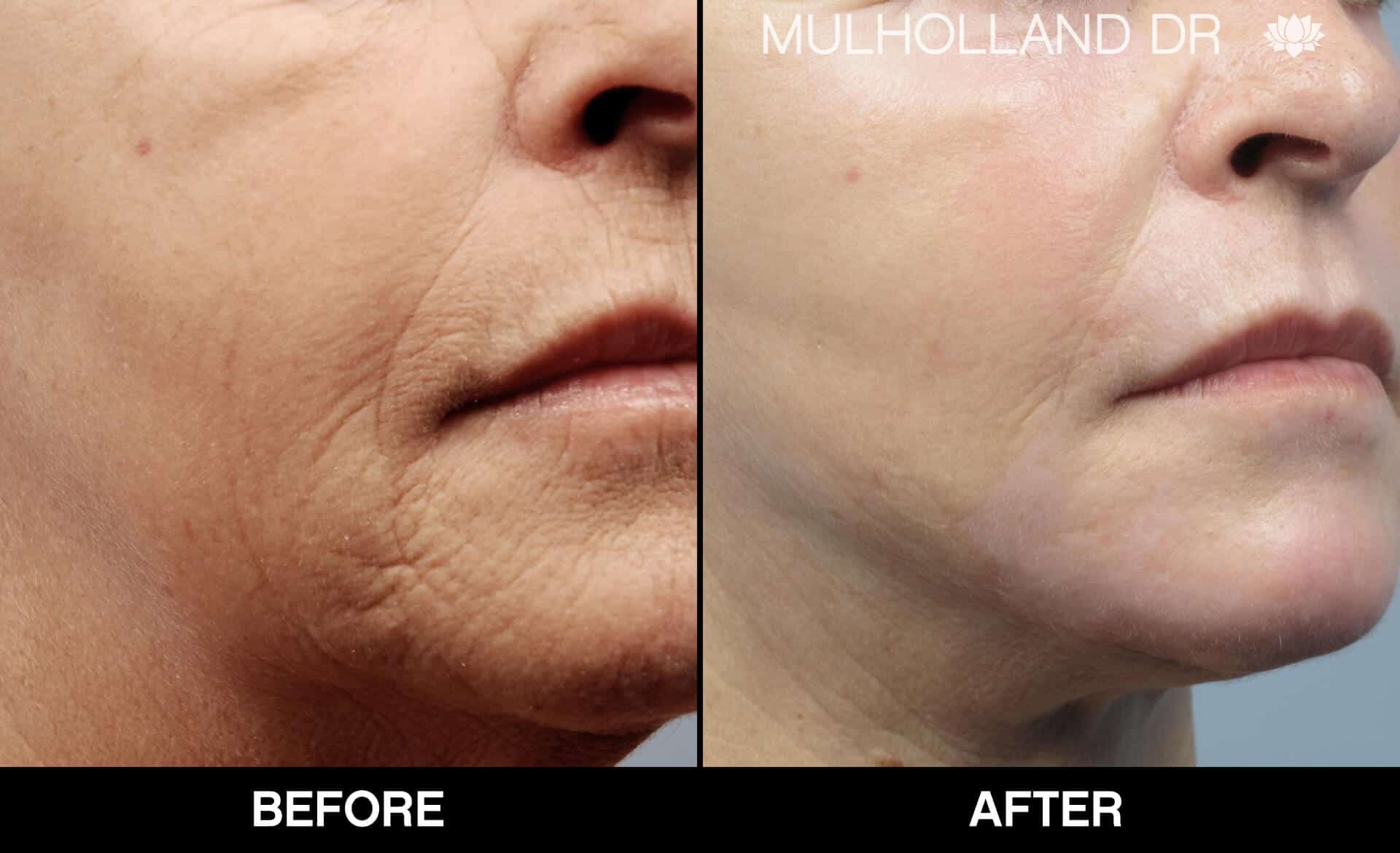 Cheek Lift - Before and After Gallery - Patient Photo 83