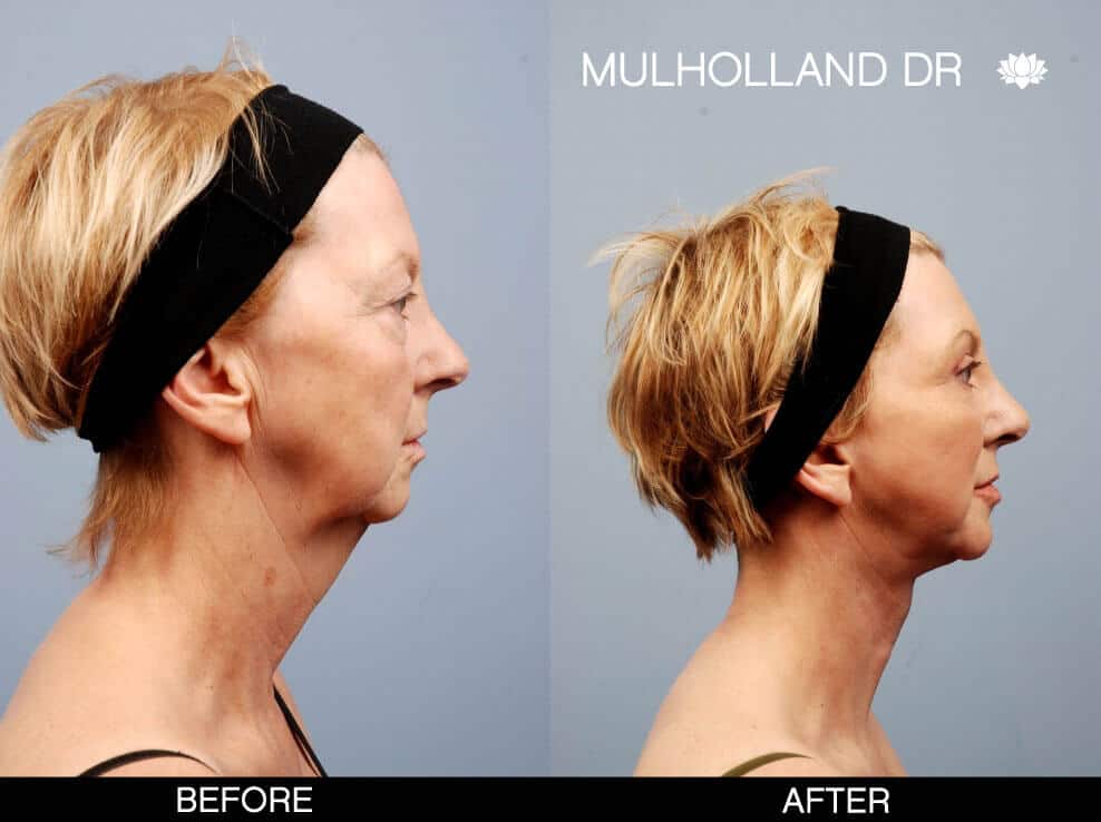 Cheek Lift - Before and After Gallery - Patient Photo 9