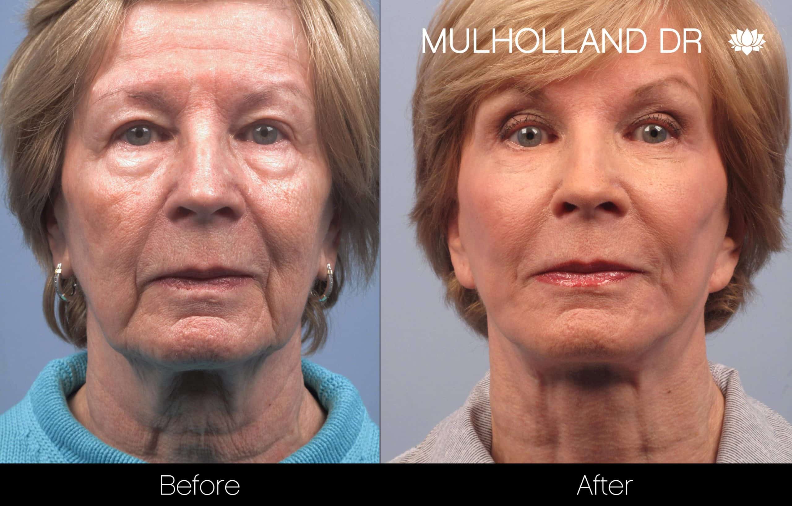 Cheek Lift - Before and After Gallery - Patient Photo 92