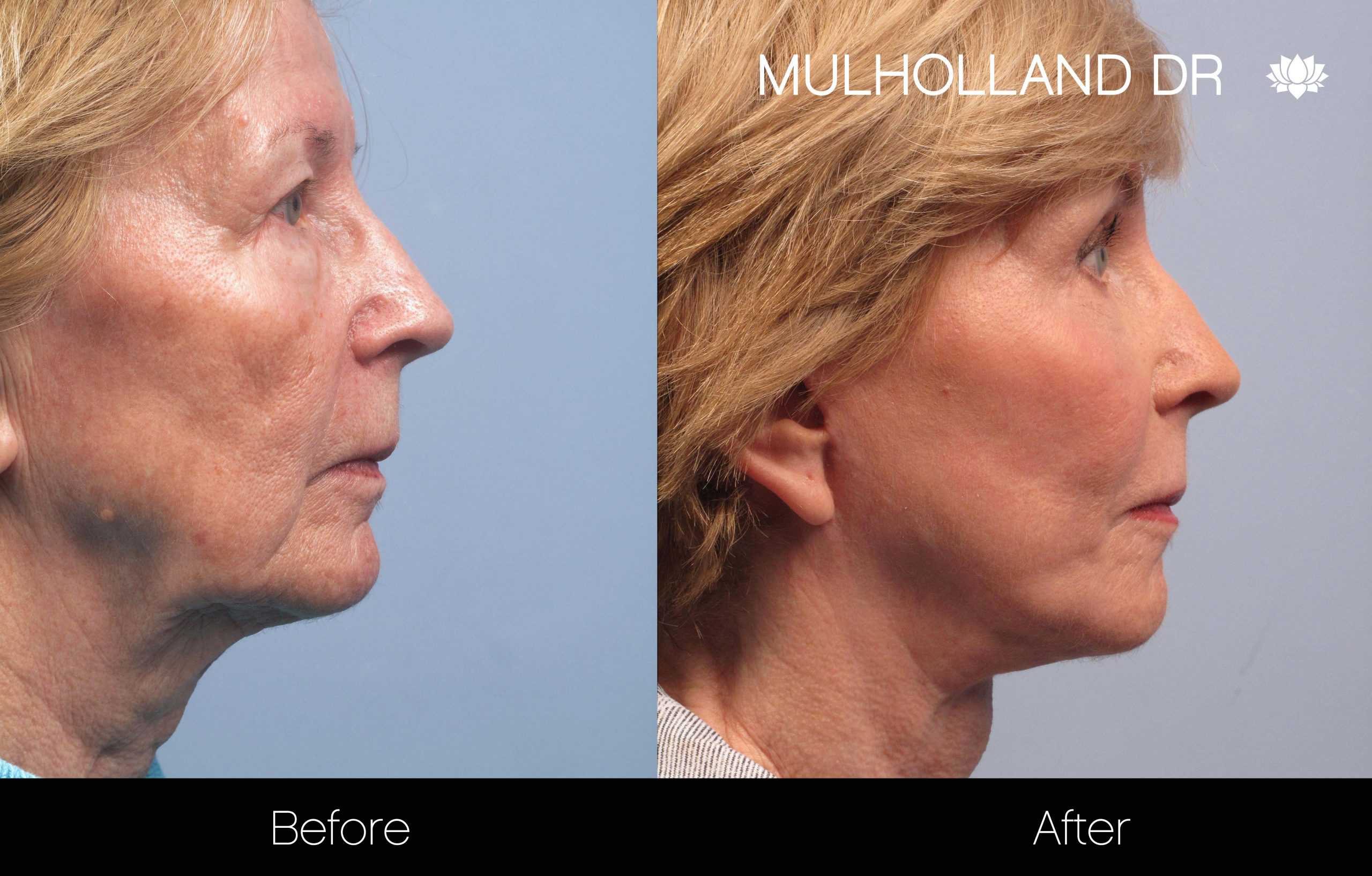Cheek Lift - Before and After Gallery - Patient Photo 93