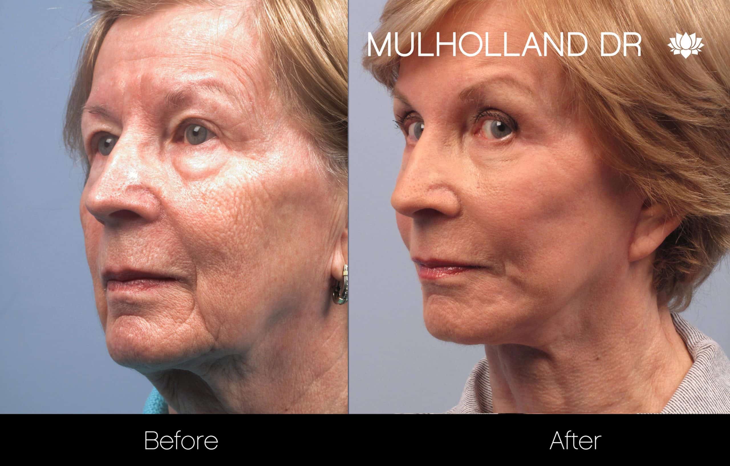 Cheek Lift - Before and After Gallery - Patient Photo 94