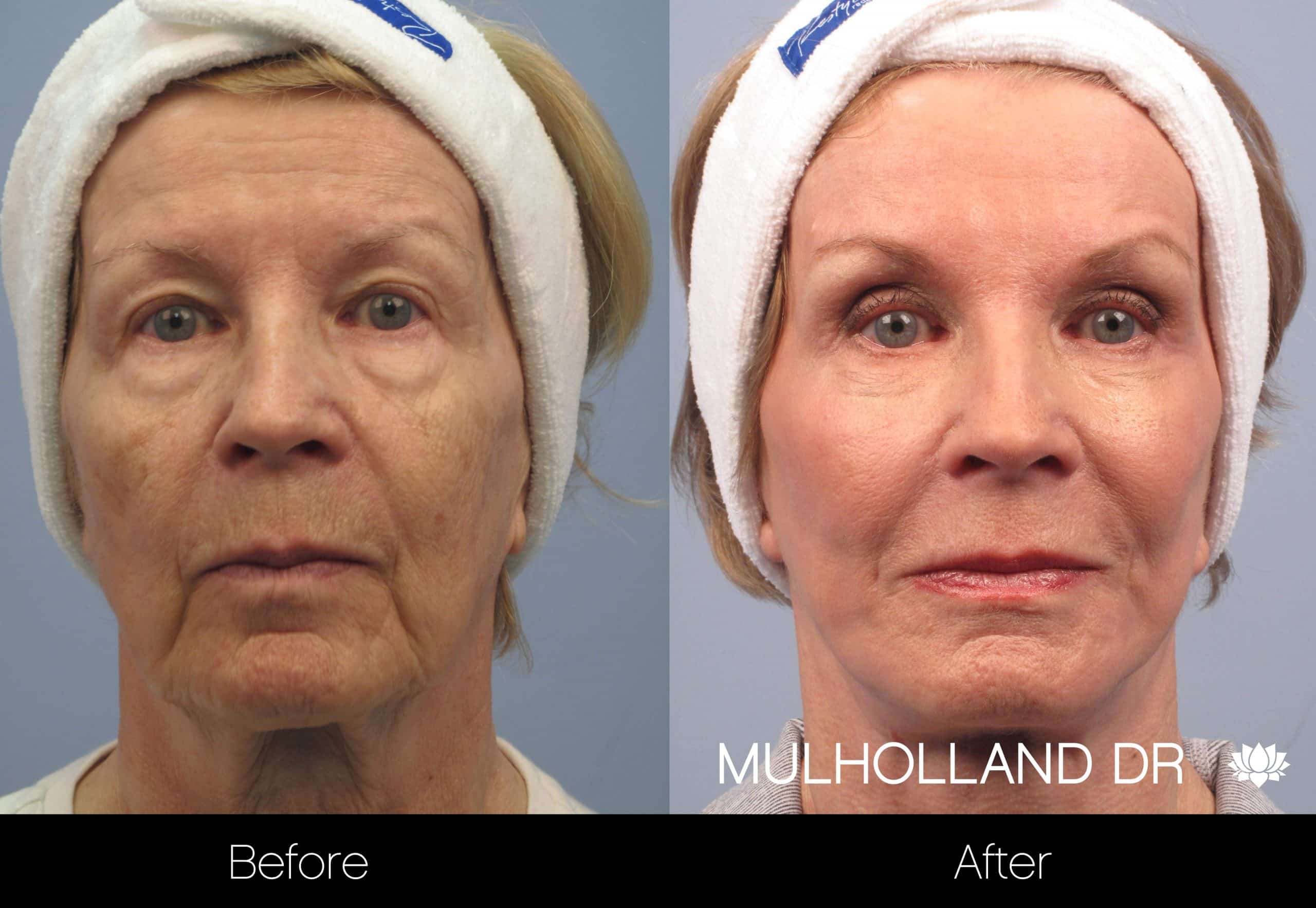 Cheek Lift - Before and After Gallery - Patient Photo 96