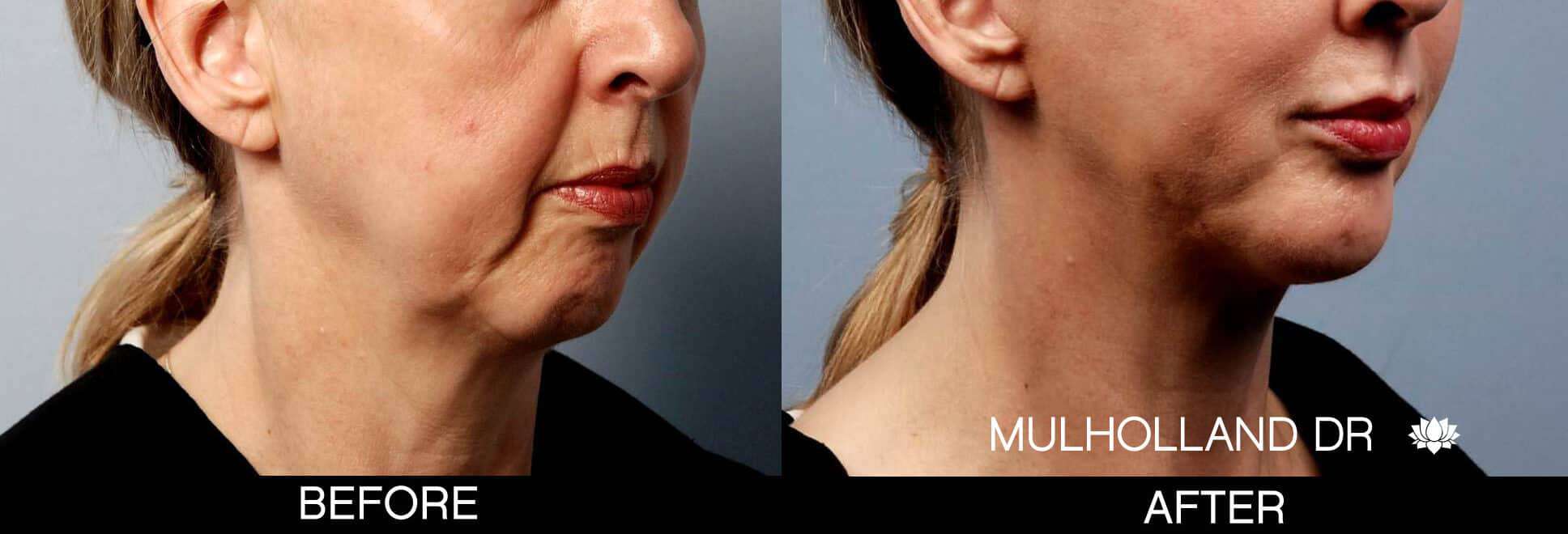 Chin Implants - Before and After Gallery - Patient Photo 2
