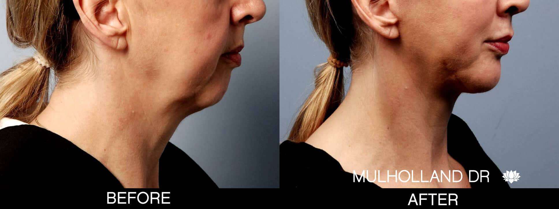 Chin Implants - Before and After Gallery - Patient Photo 3