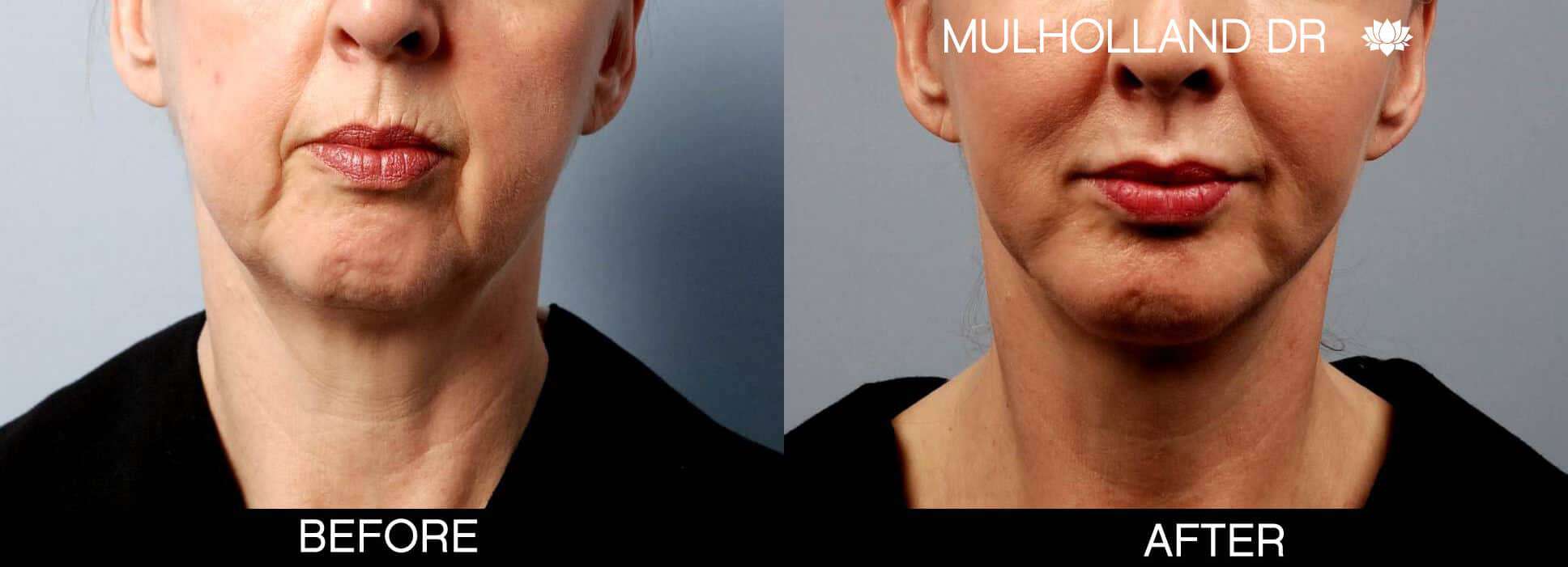 Chin Implants - Before and After Gallery - Patient Photo 5