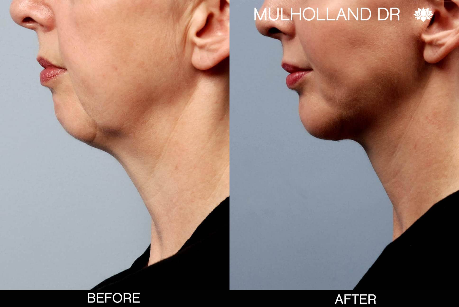 Chin Implants - Before and After Gallery - Patient Photo 6