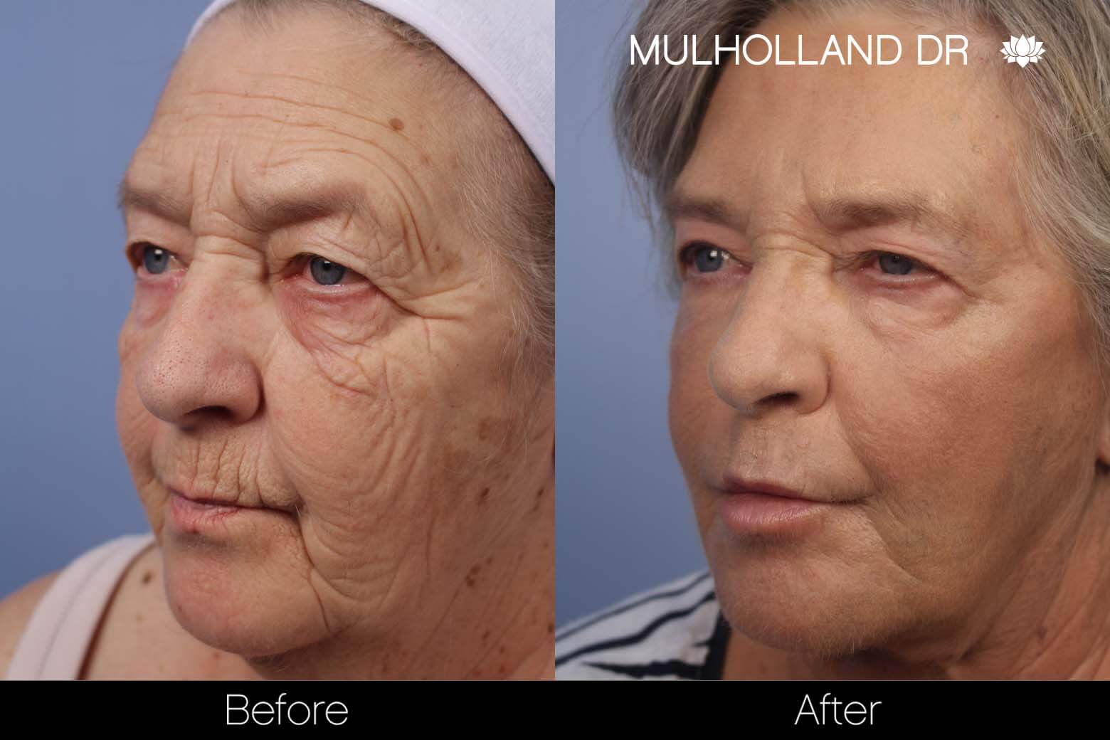 Facelift - Before and After Gallery - Patient Photo 28