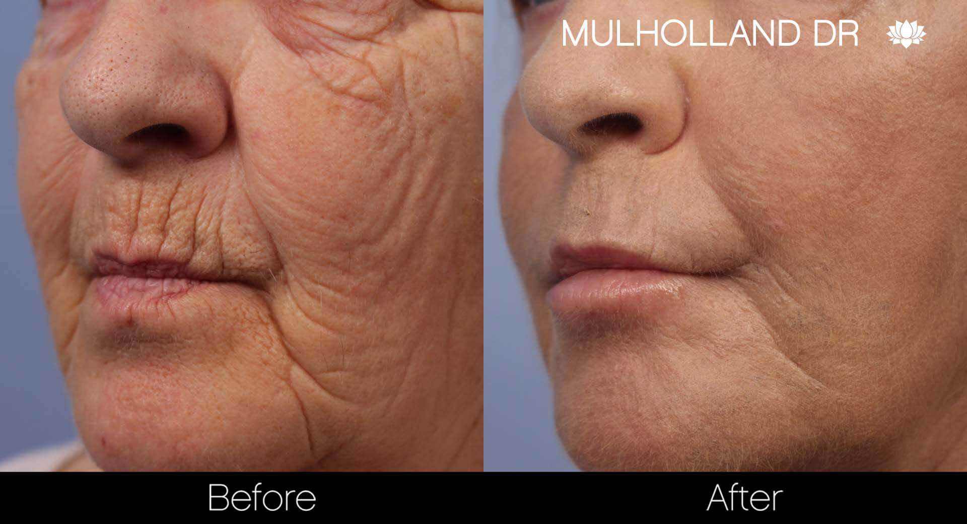 Facelift - Before and After Gallery - Patient Photo 39