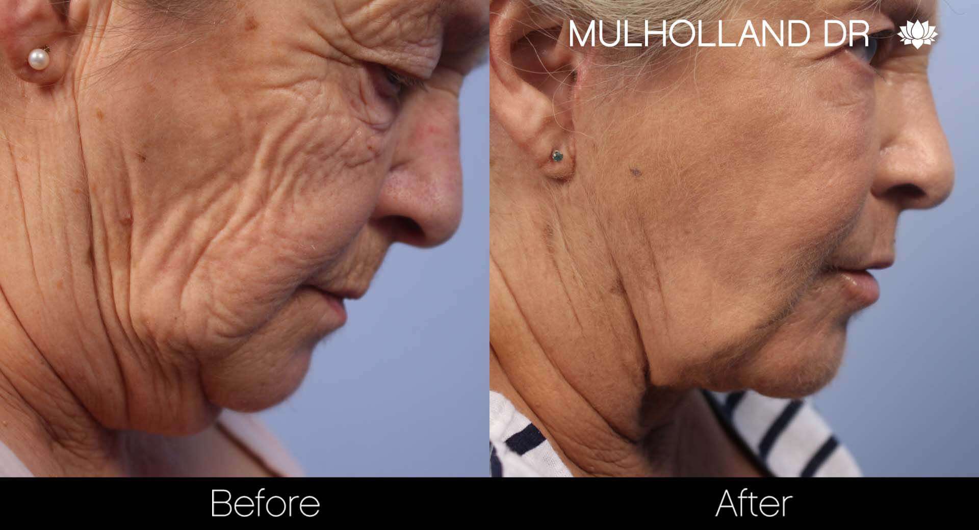 Facelift - Before and After Gallery - Patient Photo 50