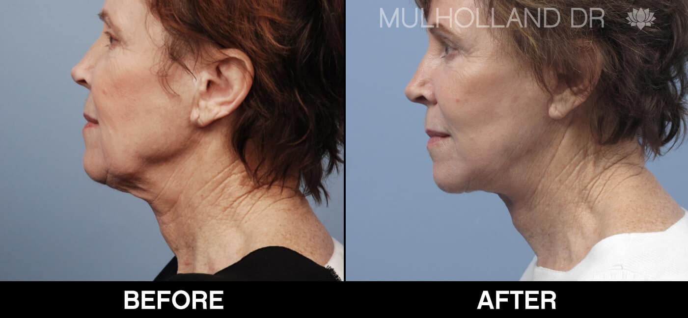 Facelift - Before and After Gallery - Patient Photo 66