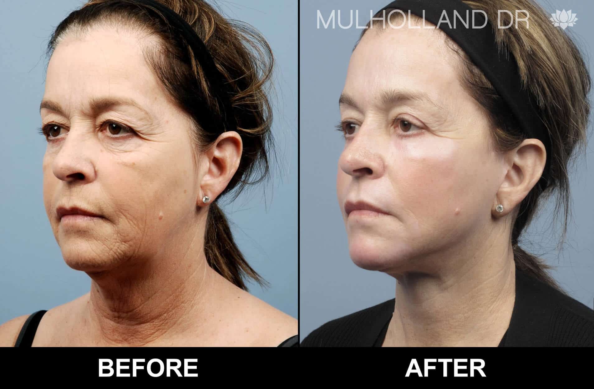 Facelift - Before and After Gallery - Patient Photo 75