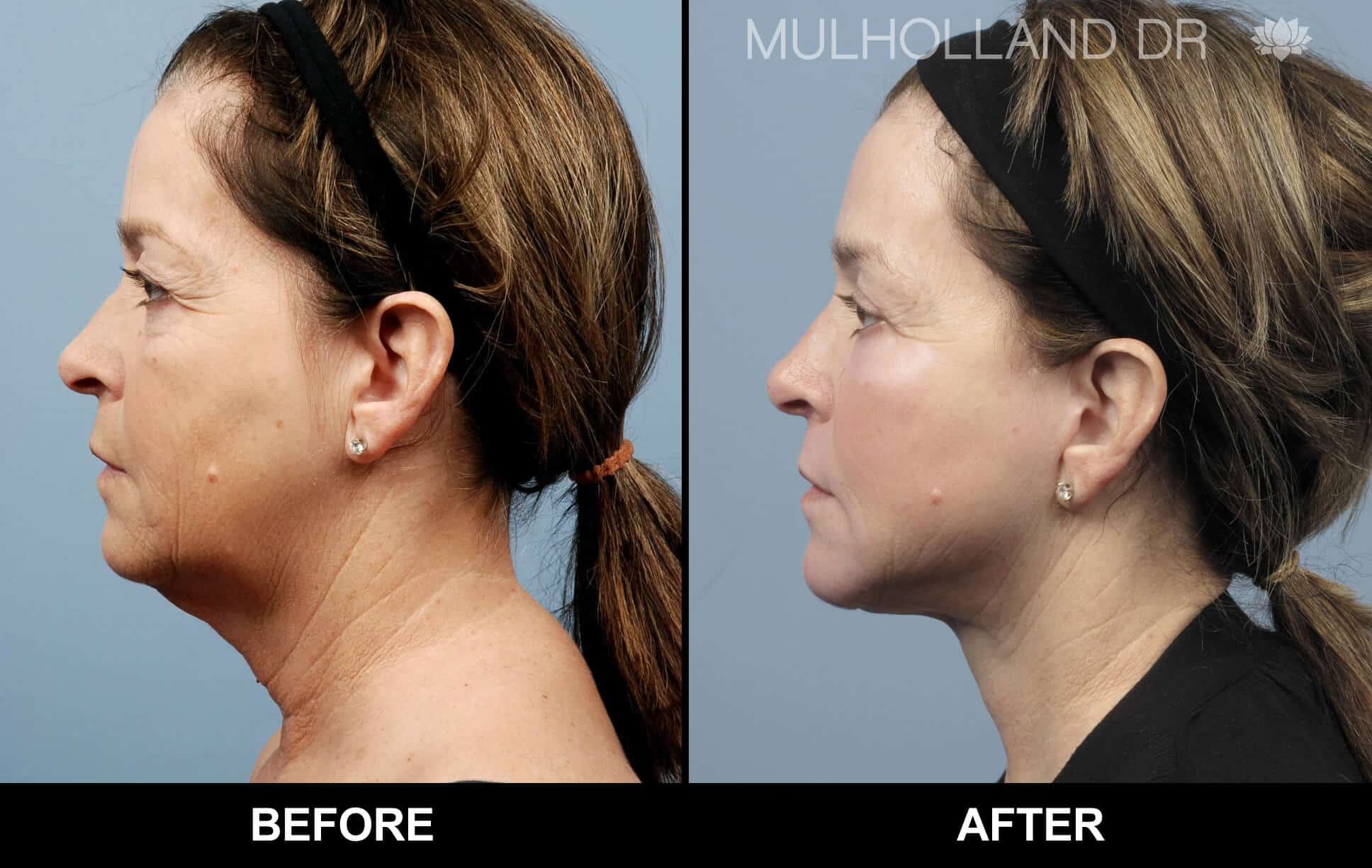 Facelift - Before and After Gallery - Patient Photo 78