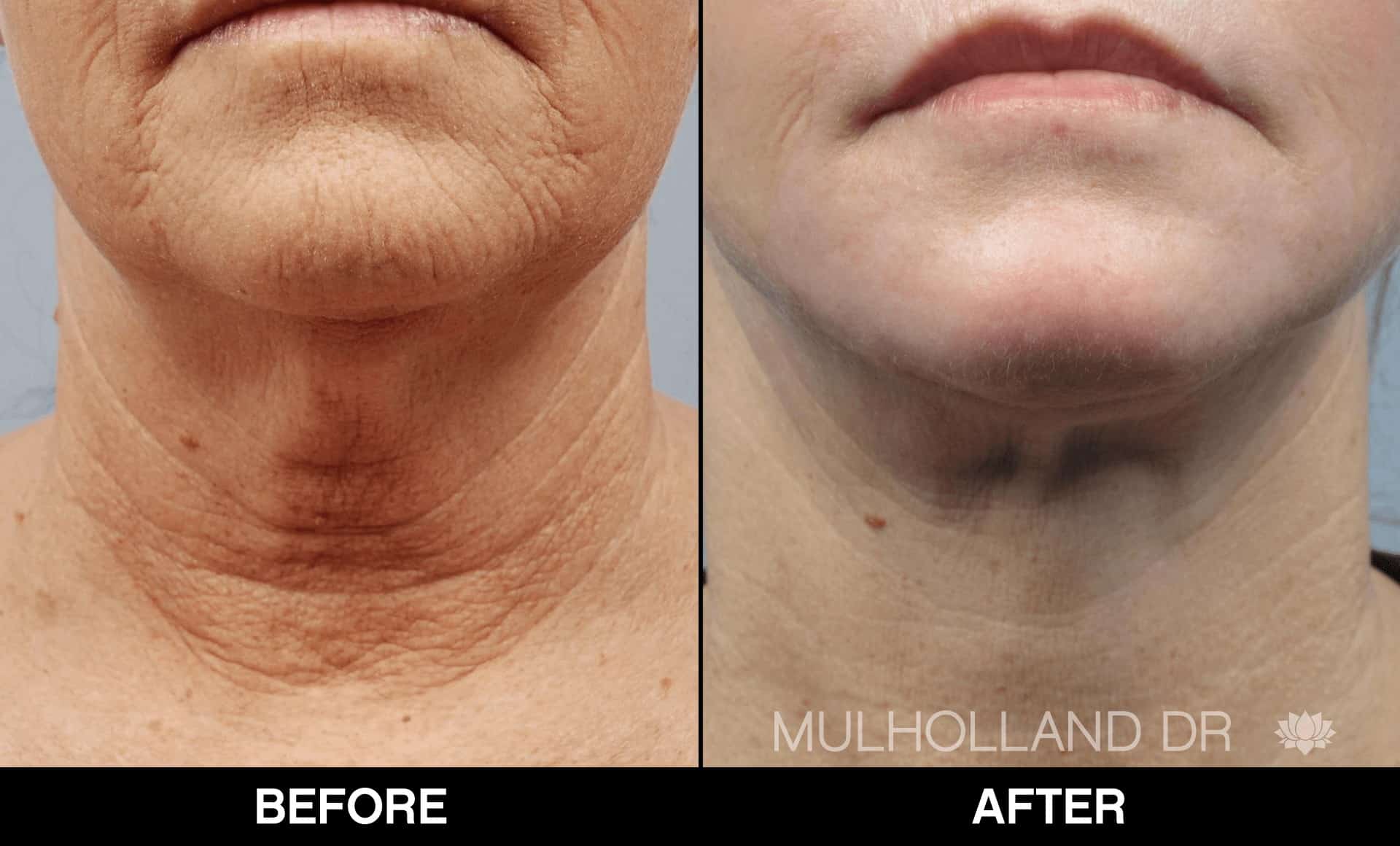 Facelift - Before and After Gallery - Patient Photo 84