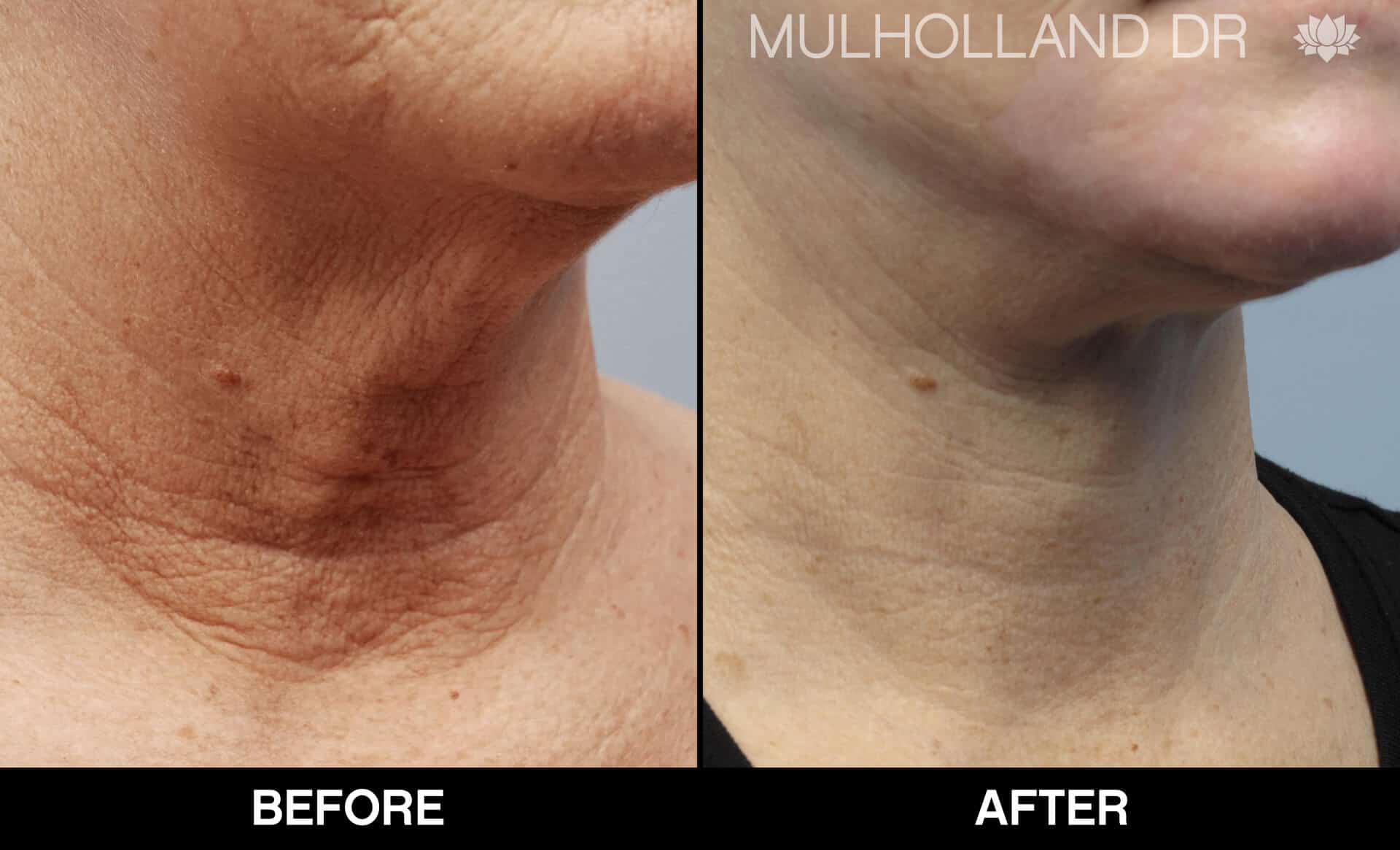 Facelift - Before and After Gallery - Patient Photo 87