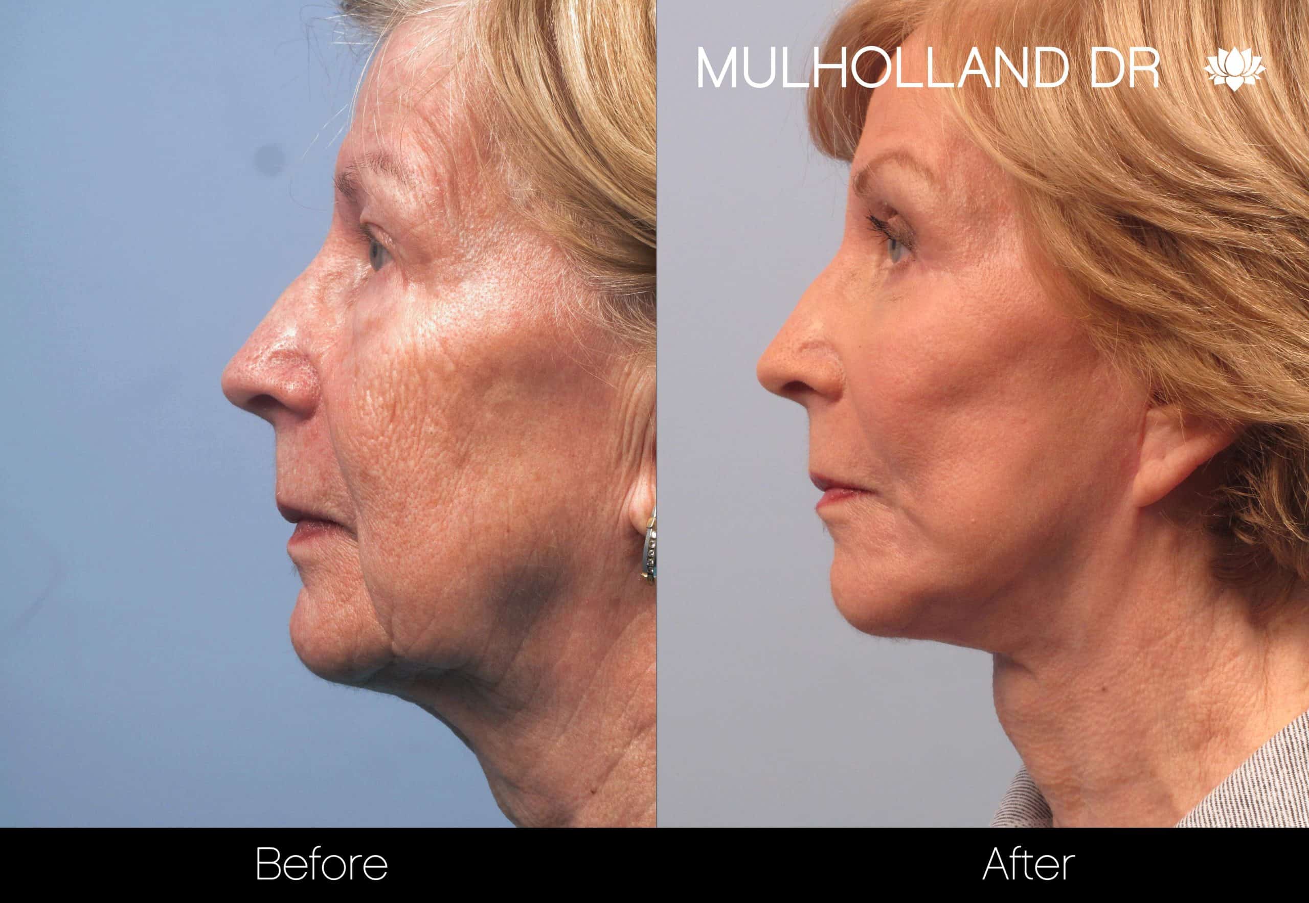 Facelift - Before and After Gallery - Patient Photo 95