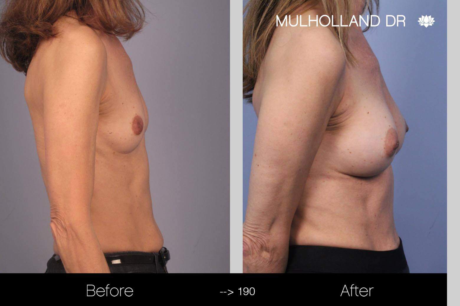 Fat Transfer Breast Augmentation - Before and After Gallery - Patient Photo 10