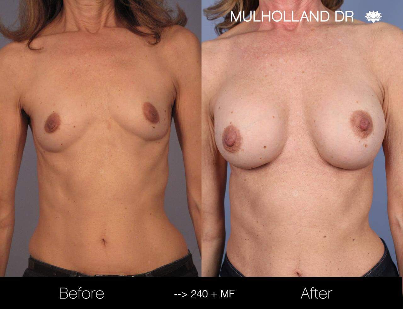 Fat Transfer Breast Augmentation - Before and After Gallery - Patient Photo 11