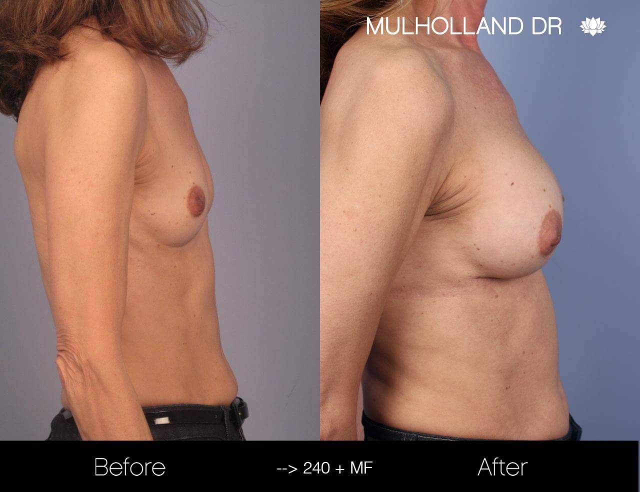 Fat Transfer Breast Augmentation - Before and After Gallery - Patient Photo 12