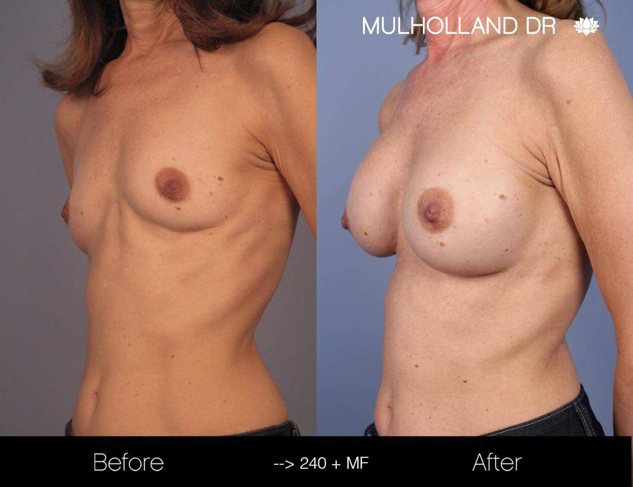 Fat Transfer Breast Augmentation - Before and After Gallery - Patient Photo 14