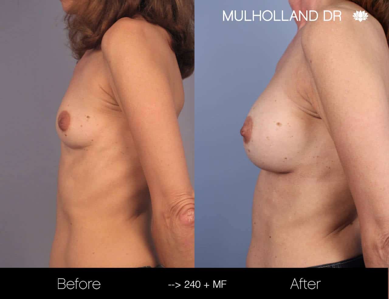 Fat Transfer Breast Augmentation - Before and After Gallery - Patient Photo 15