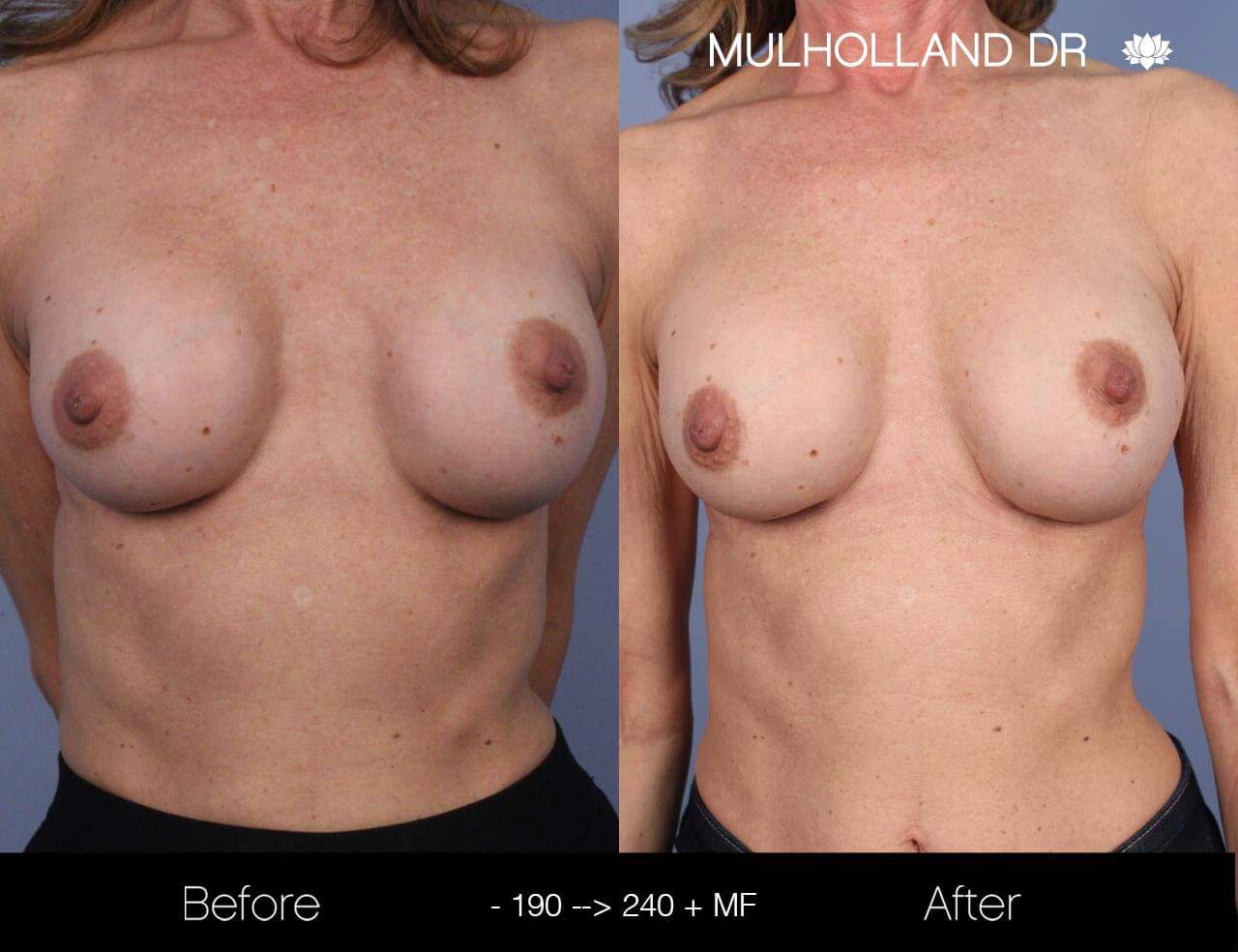 Fat Transfer Breast Augmentation - Before and After Gallery - Patient Photo 16