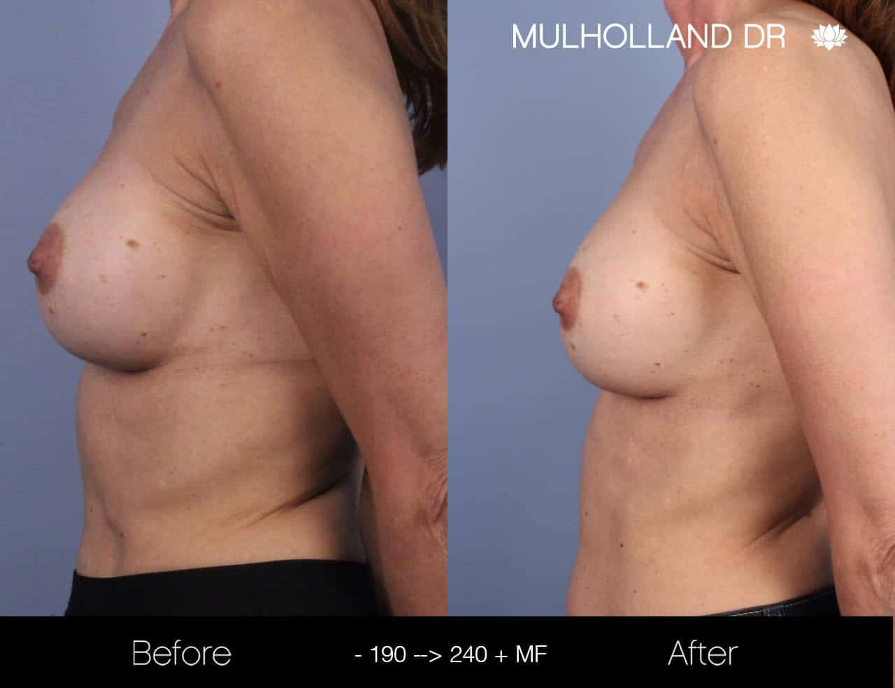 Fat Transfer Breast Augmentation - Before and After Gallery - Patient Photo 18