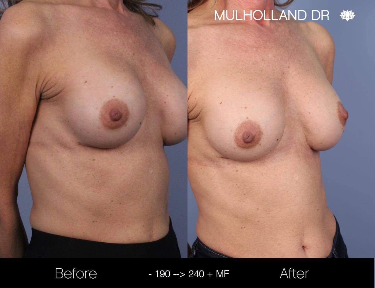Fat Transfer Breast Augmentation - Before and After Gallery - Patient Photo 19