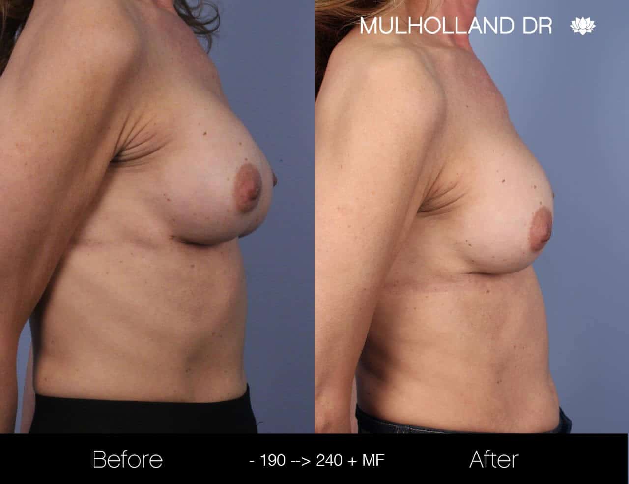 Fat Transfer Breast Augmentation - Before and After Gallery - Patient Photo 20