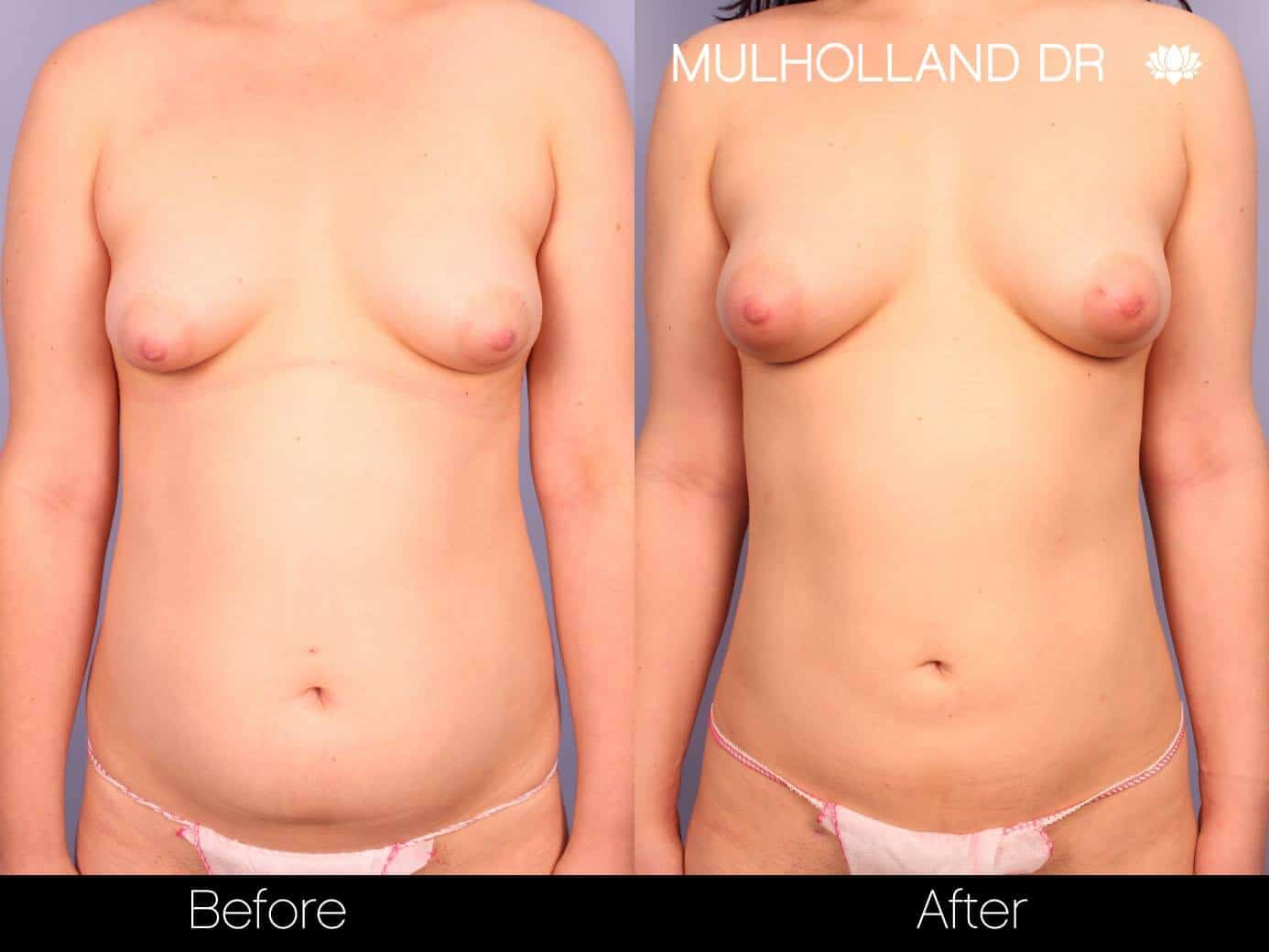 Fat Transfer Breast Augmentation - Before and After Gallery - Patient Photo 21