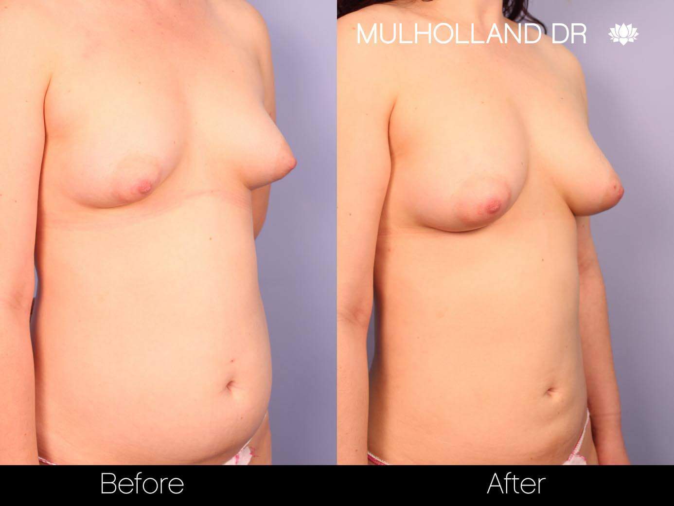 Fat Transfer Breast Augmentation - Before and After Gallery - Patient Photo 24