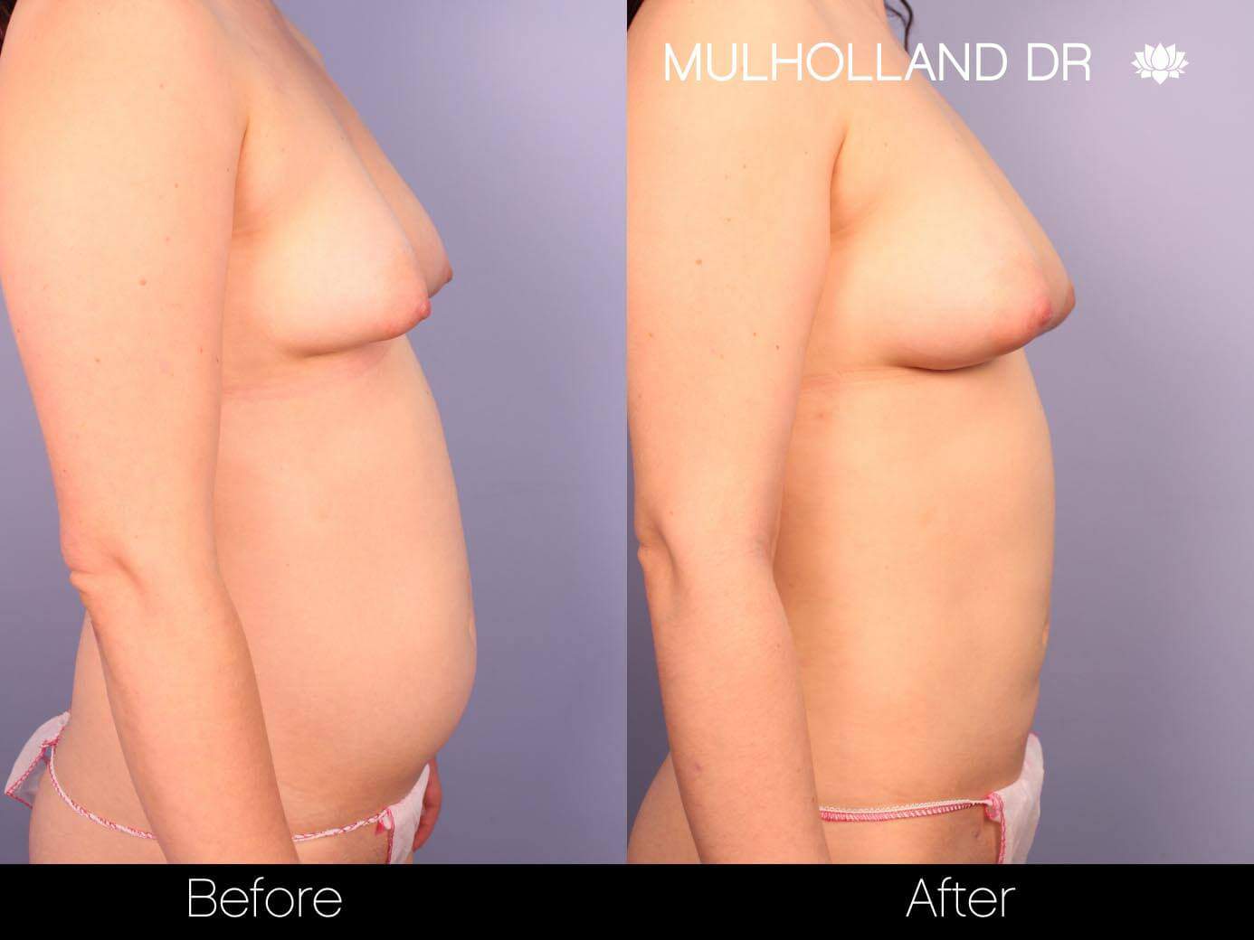 Fat Transfer Breast Augmentation - Before and After Gallery - Patient Photo 25