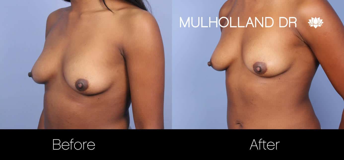 Fat Transfer Breast Augmentation - Before and After Gallery - Patient Photo 26